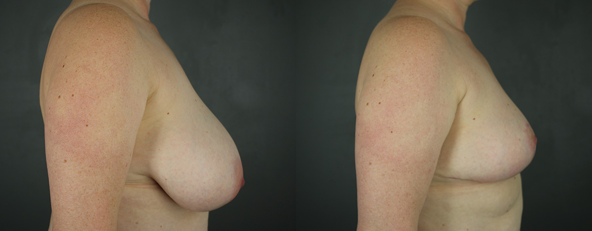 Case--4798 | Before and After Breast Reduction 3