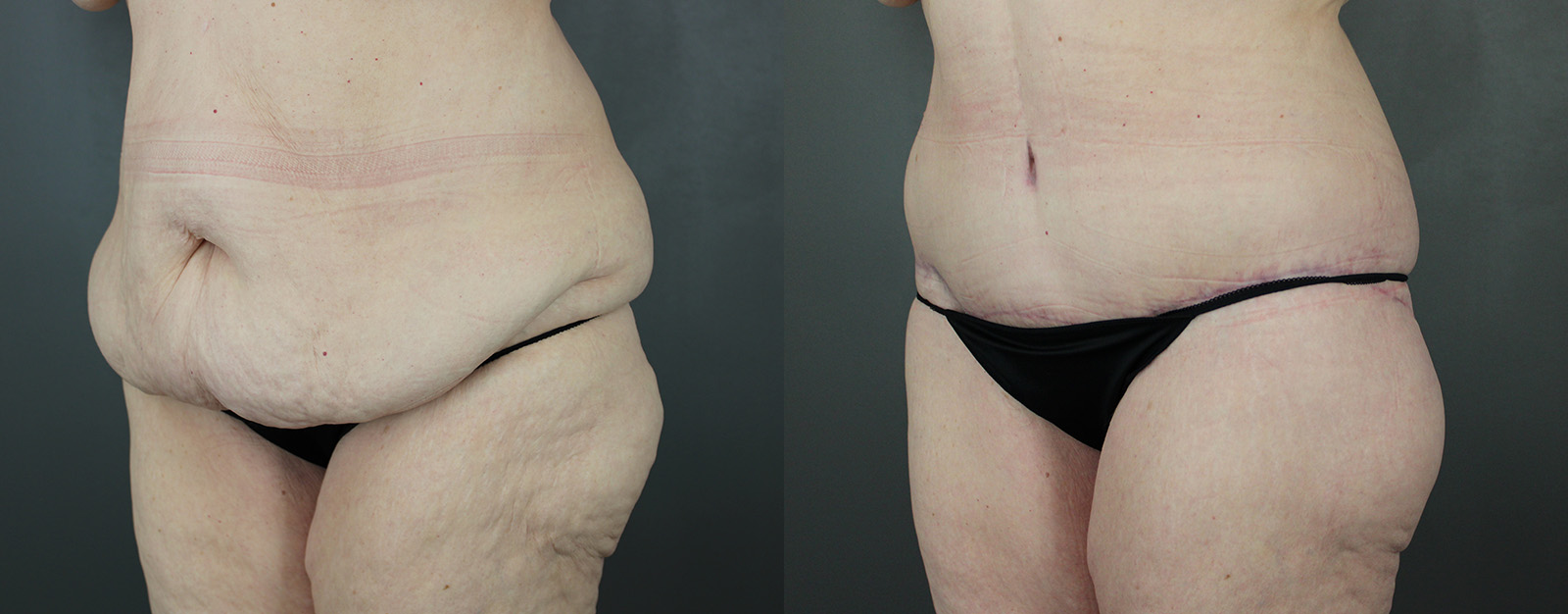 Case--8832 | Before and After Body Lift 2