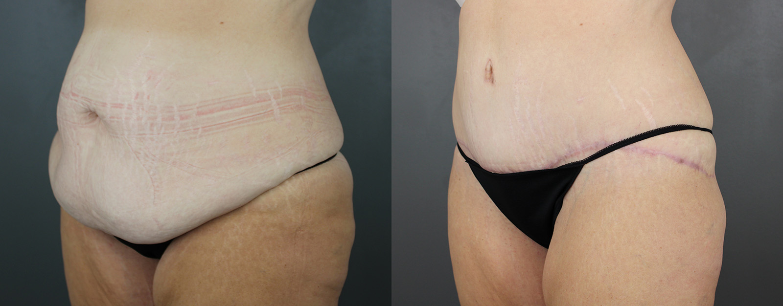 Case--2674 | Before and After Body Lift 2