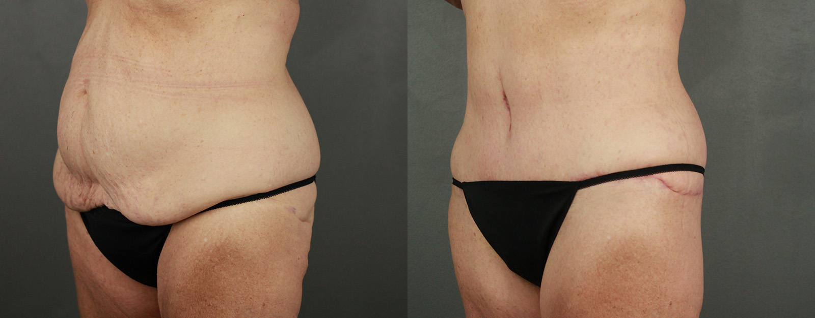 Case--3542 | Before and After Body Lift 2