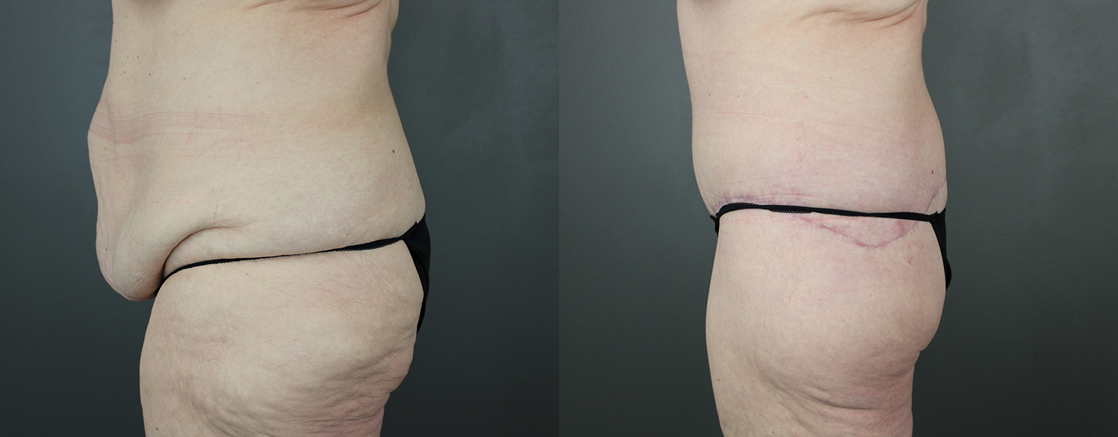 Case--8832 | Before and After Body Lift 3
