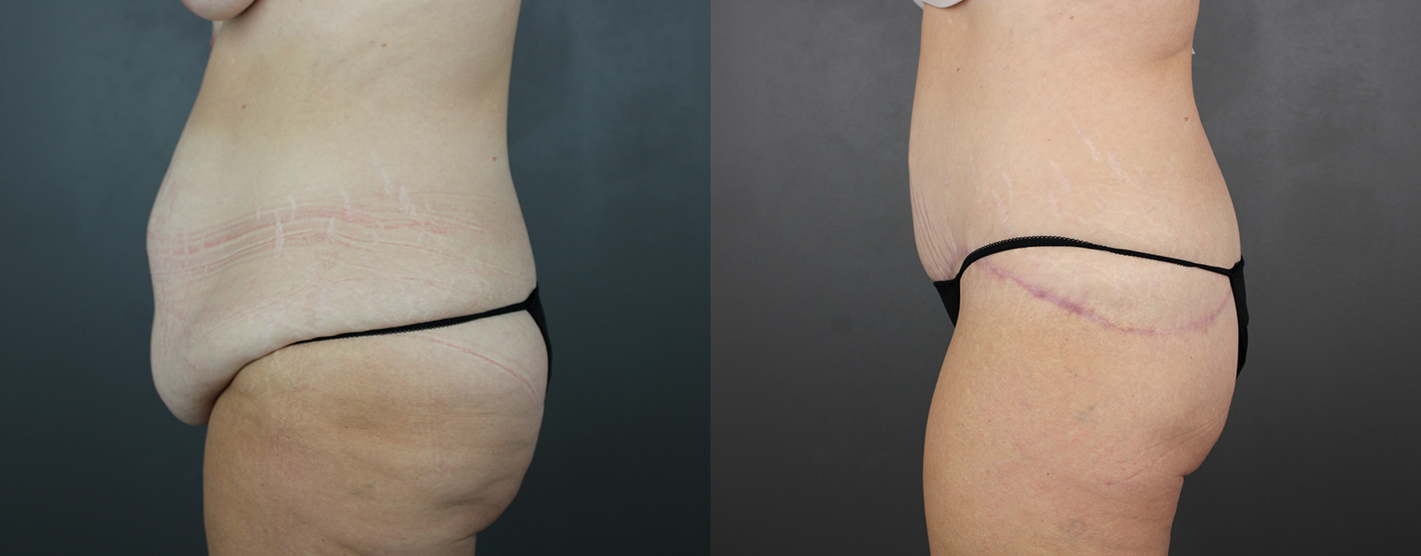 Case--2674 | Before and After Body Lift 3