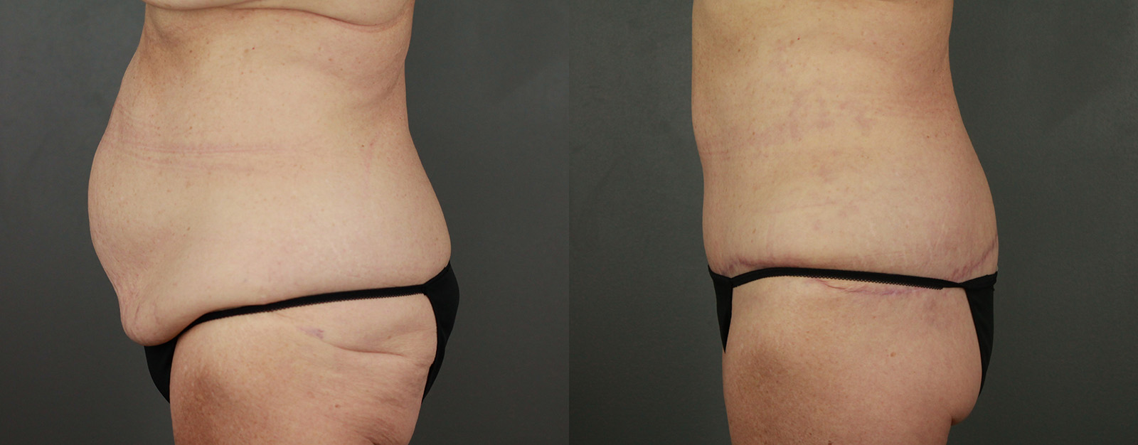 Case--3542 | Before and After Body Lift 3