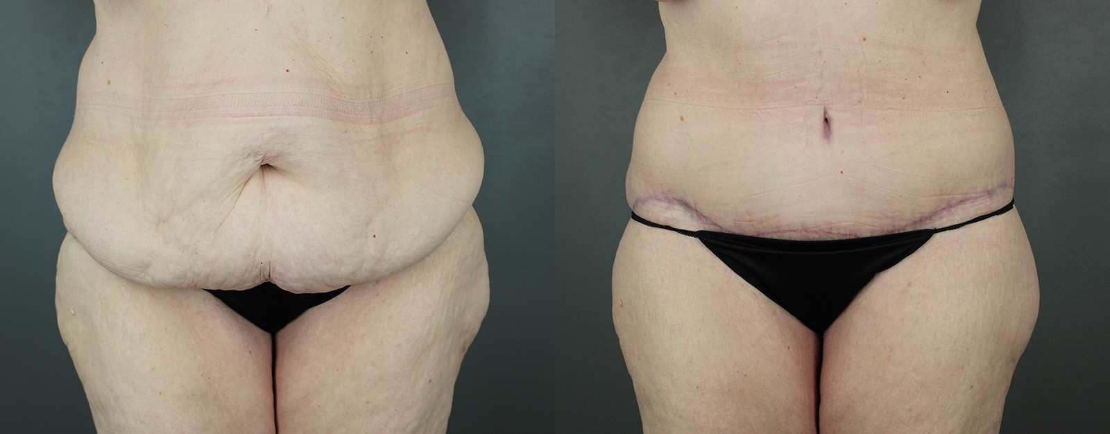 Case--8832 | Before and After Body
