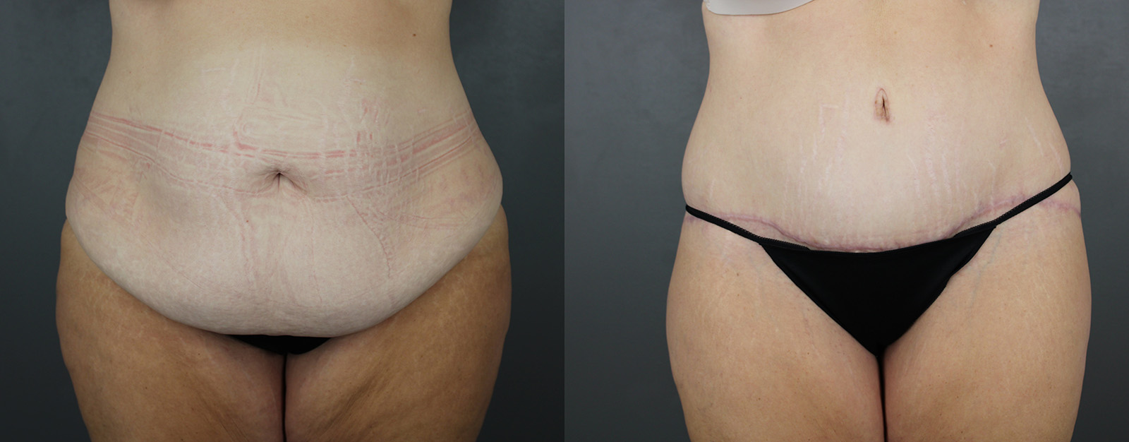Case--2674 | Before and After Body