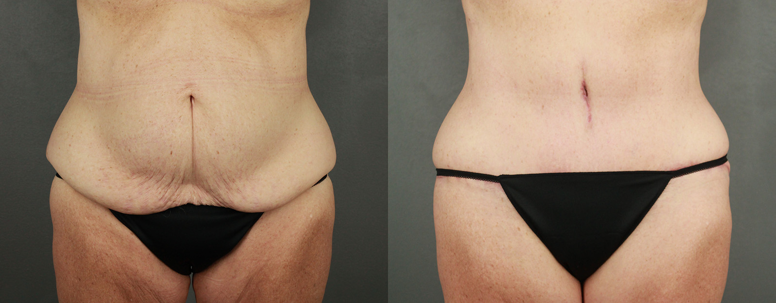 Case--3542 | Before and After Body