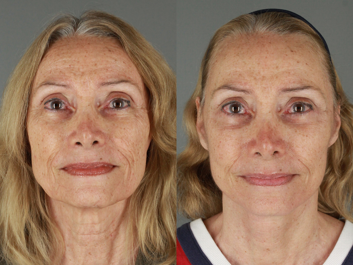 Case--3566 | Before and After Facelift