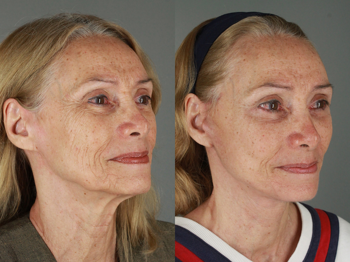 Case--3566 | Before and After Eyelid Lift 2