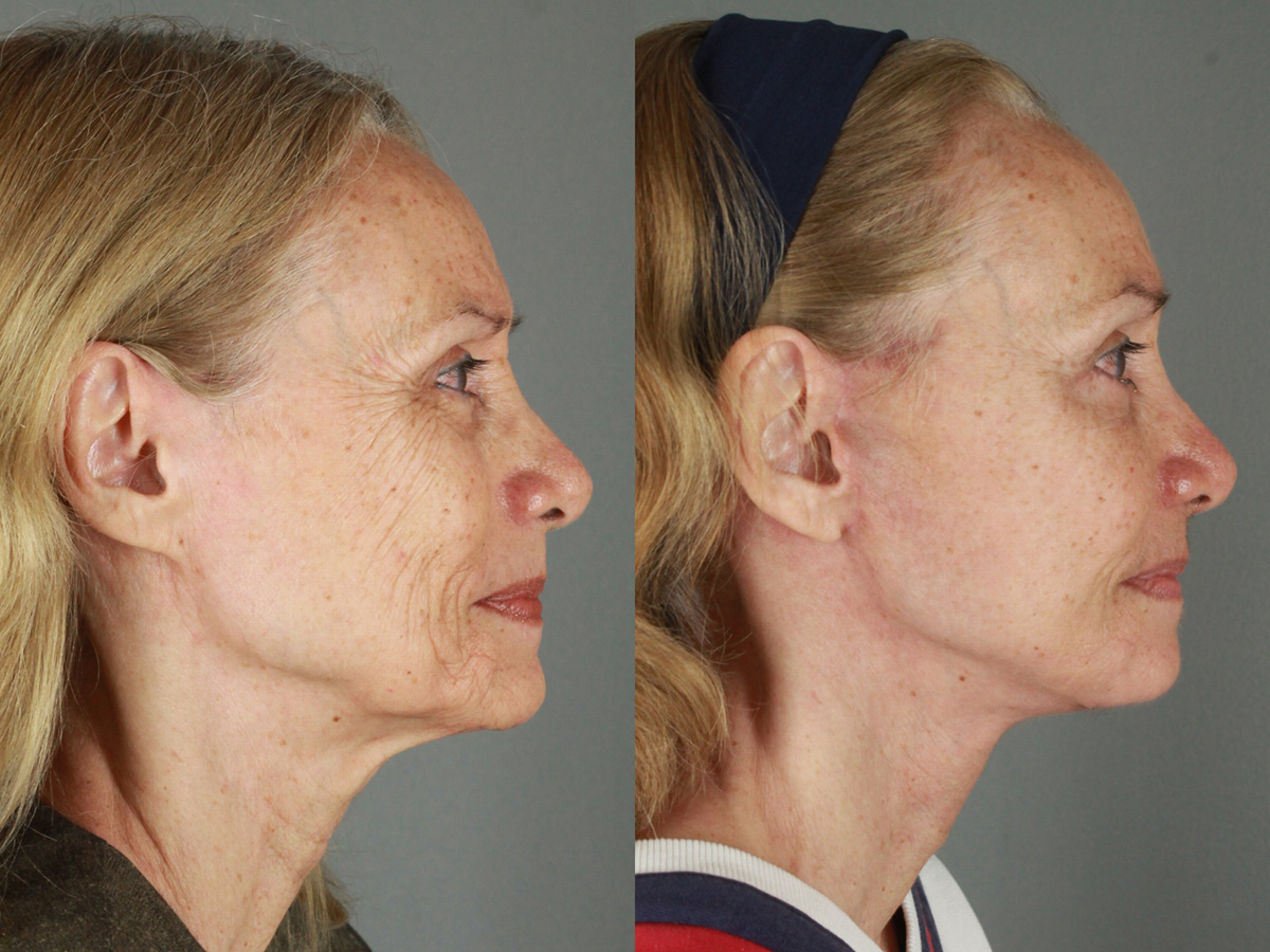 Case--3566 | Before and After Eyelid Lift 3