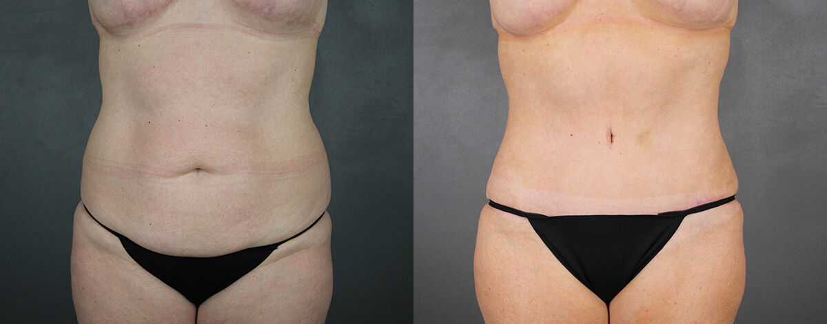 Case--9134 | Before and After Liposuction Procedures