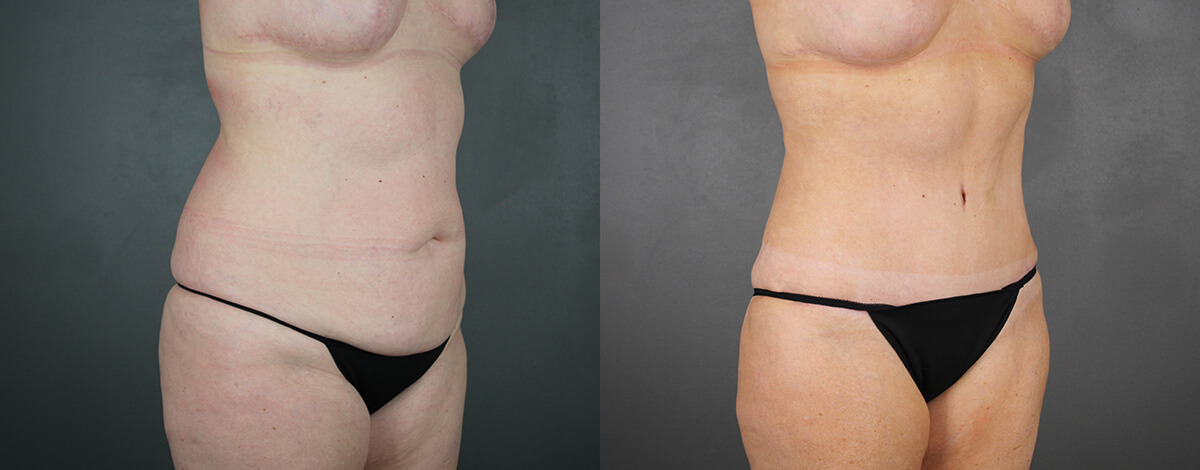 Case--9134 | Before and After Liposuction Procedures 2