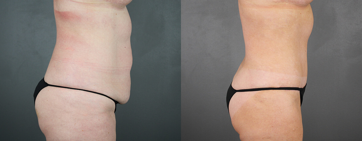 Case--9134 | Before and After Liposuction Procedures 3