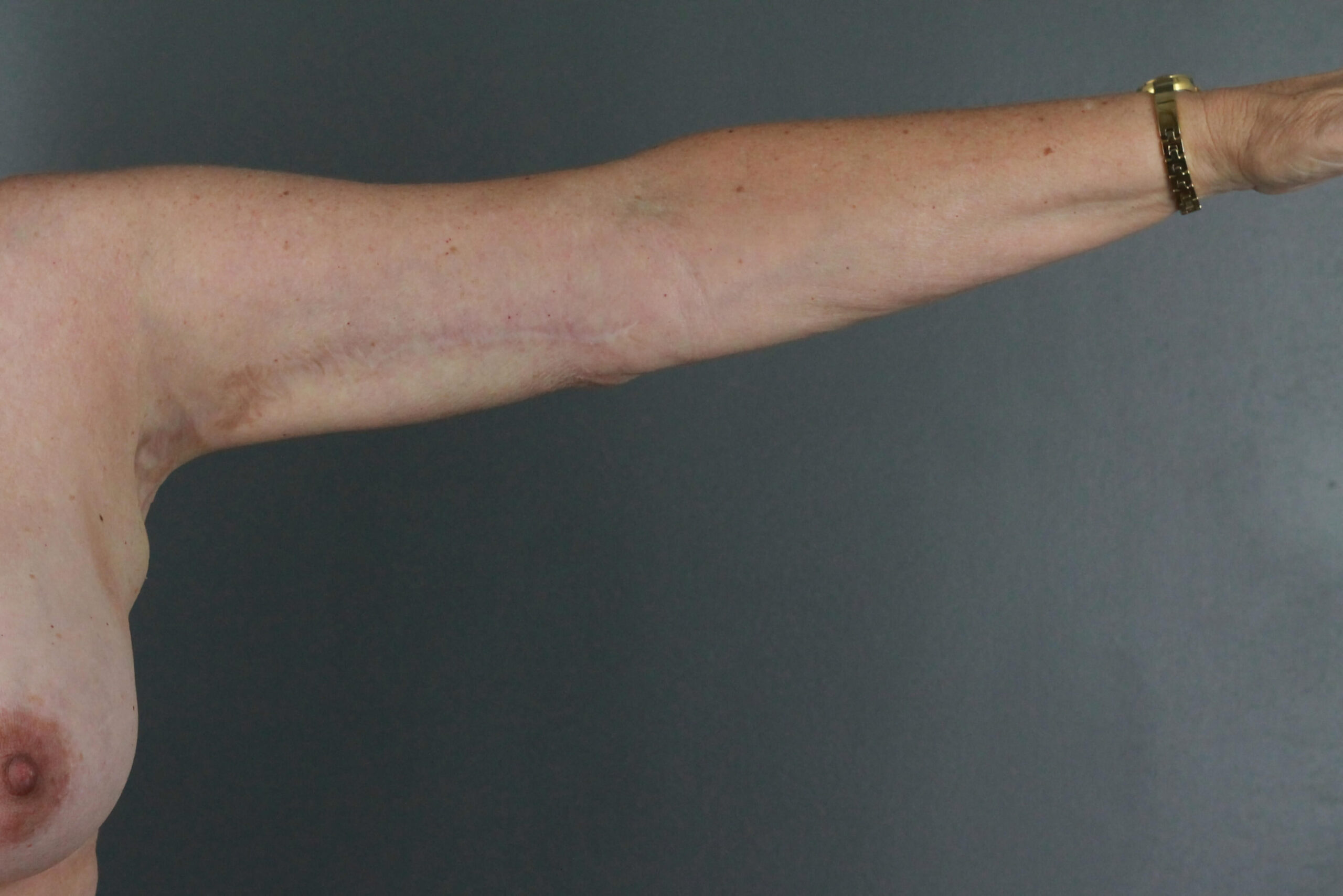 Case--6030 | After Arm Lift 4