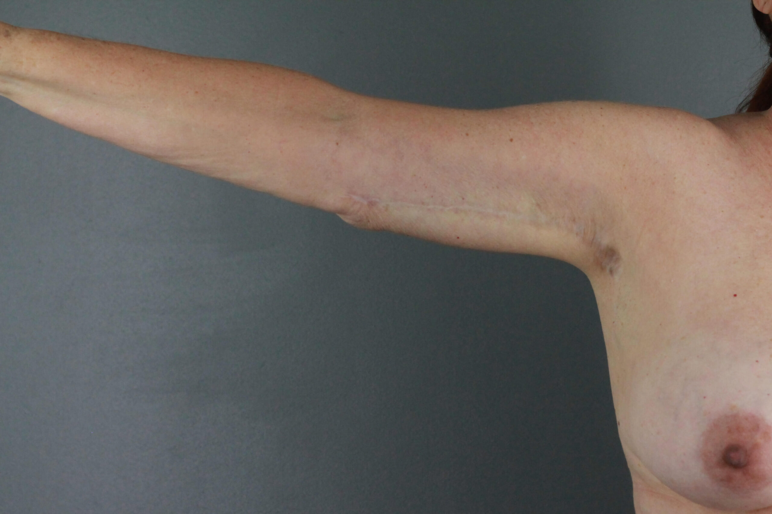 Case--6030 | After Arm Lift 5