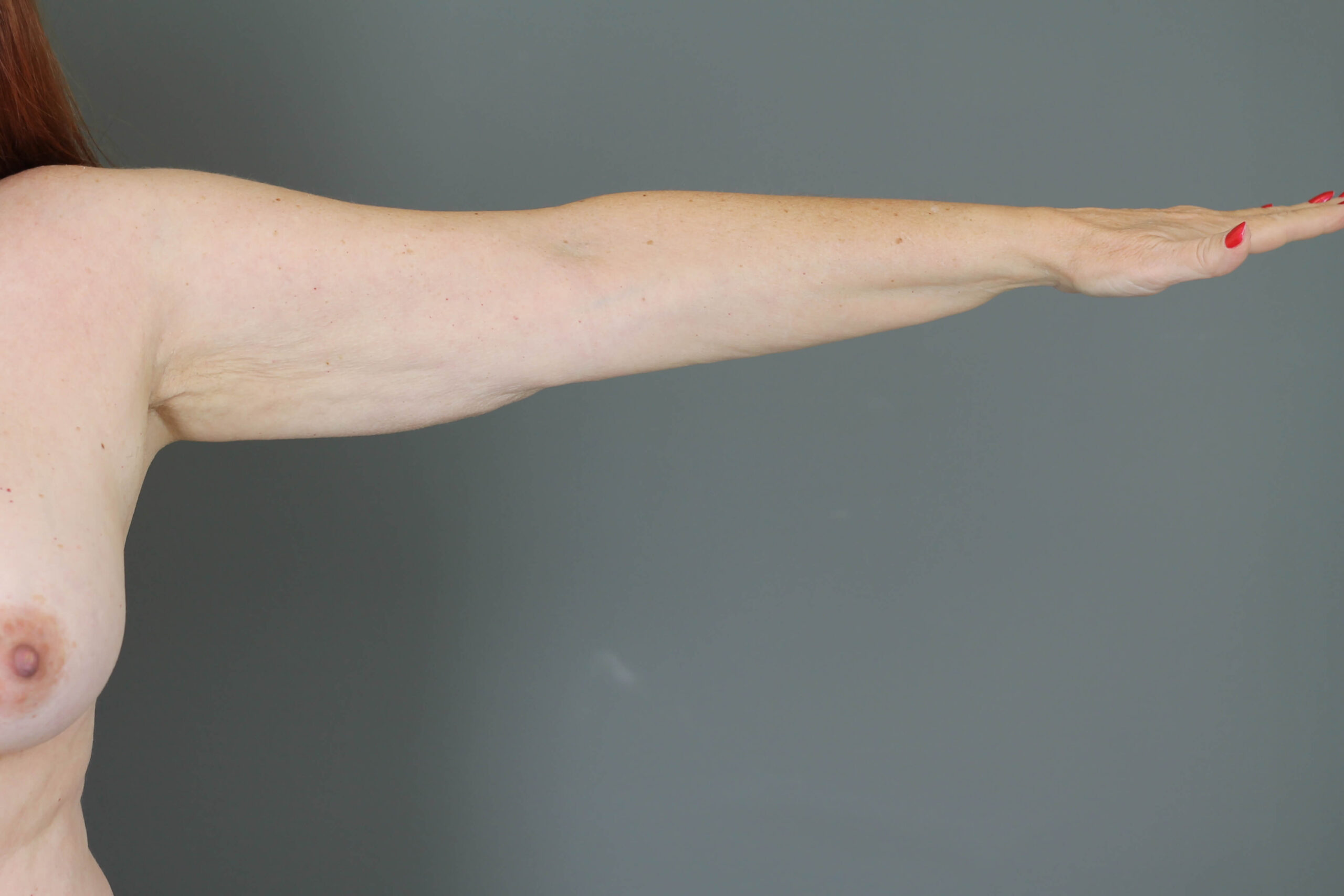 Case--6030 | Before Arm Lift 4