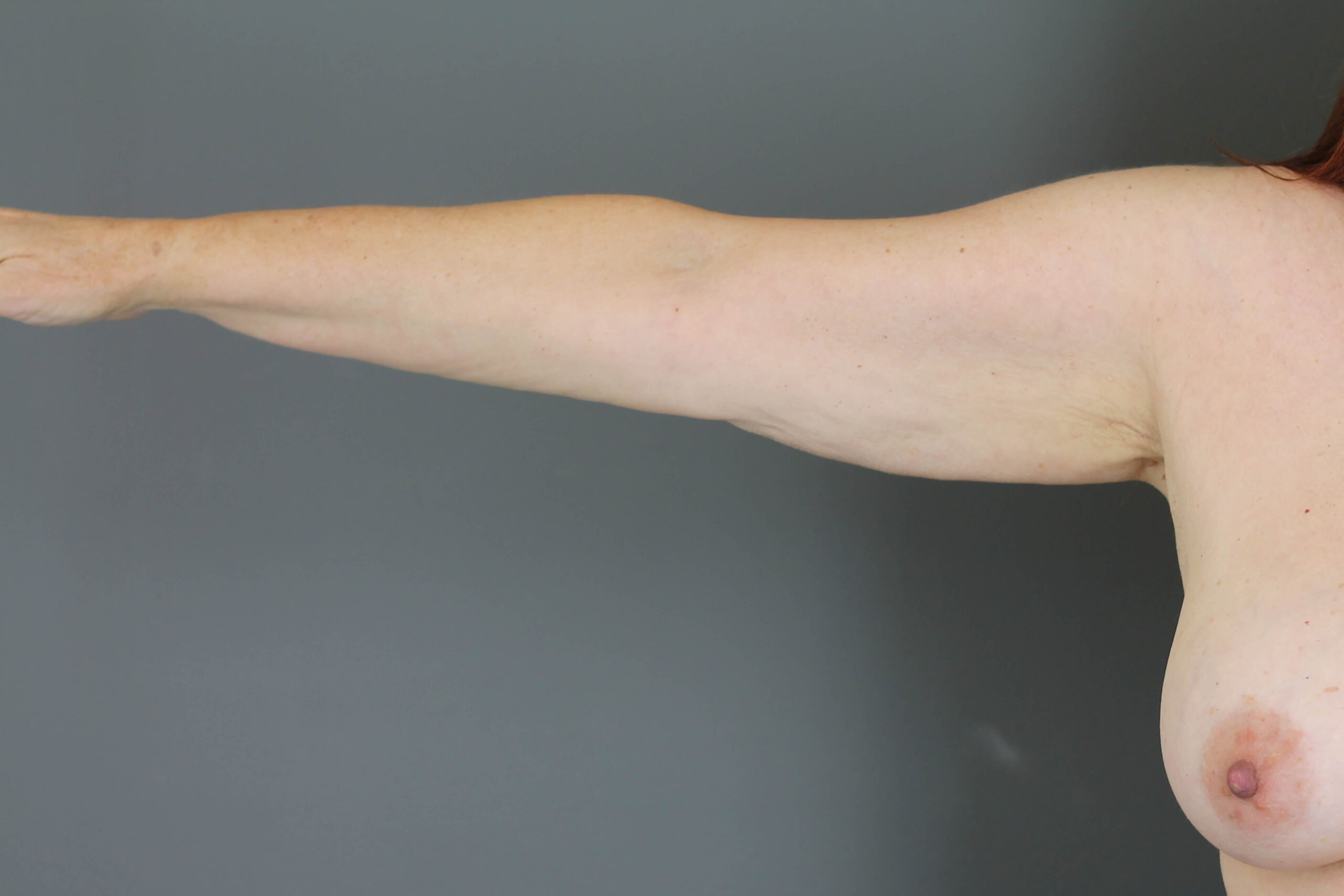 Case--6030 | Before Arm Lift 5