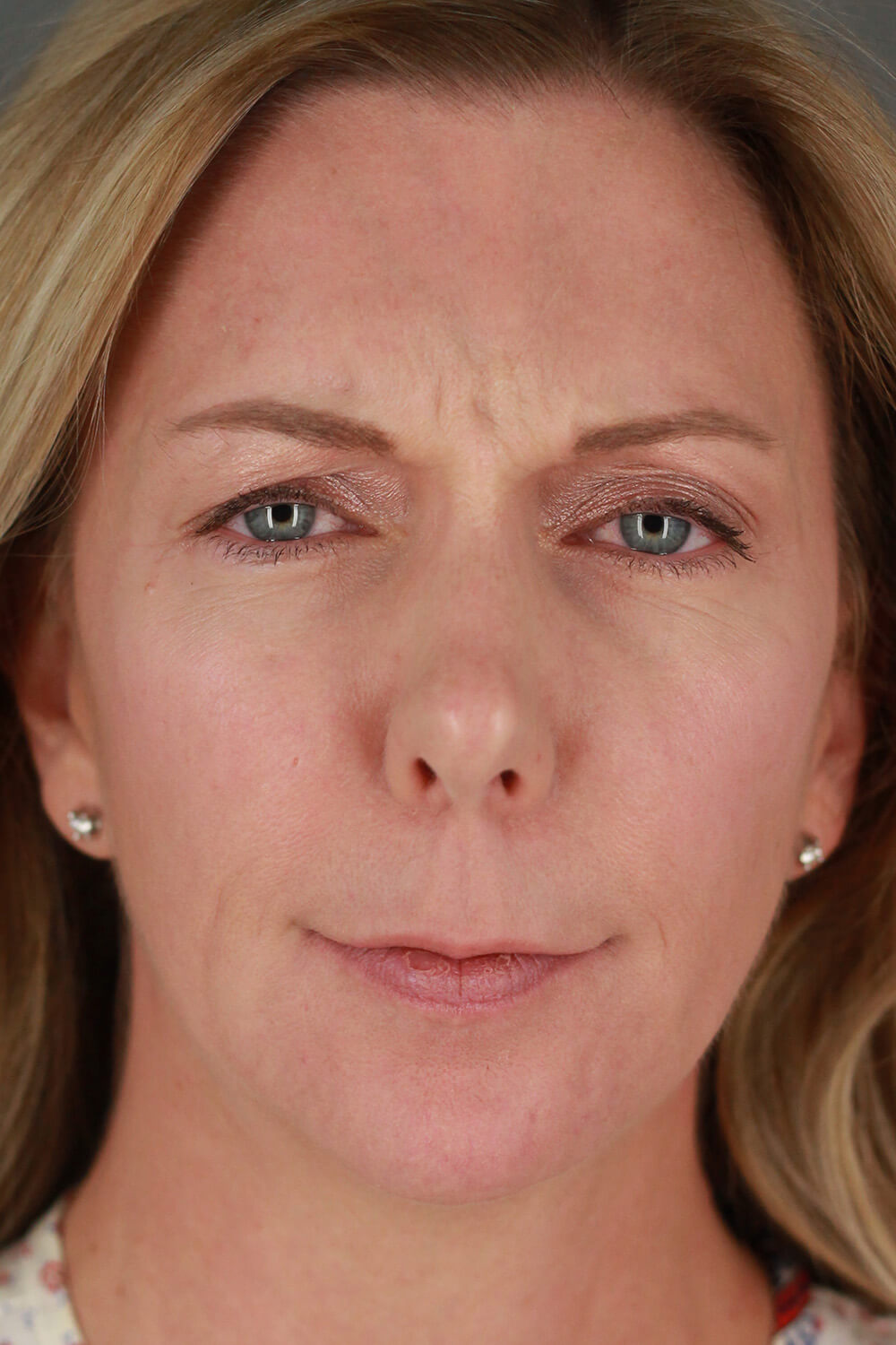 Case--3213 | After Voluma 2