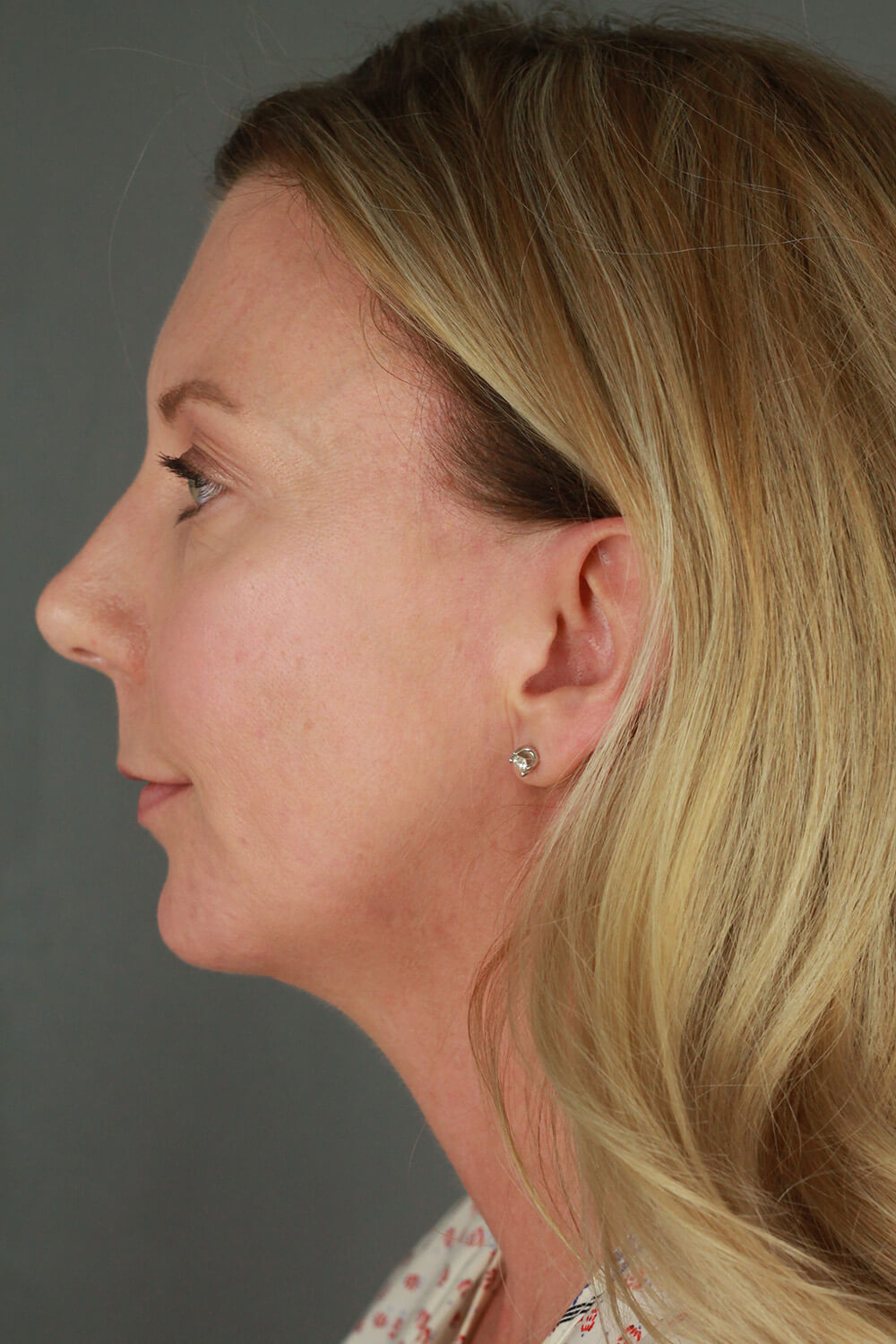 Case--3213 | After Voluma 3