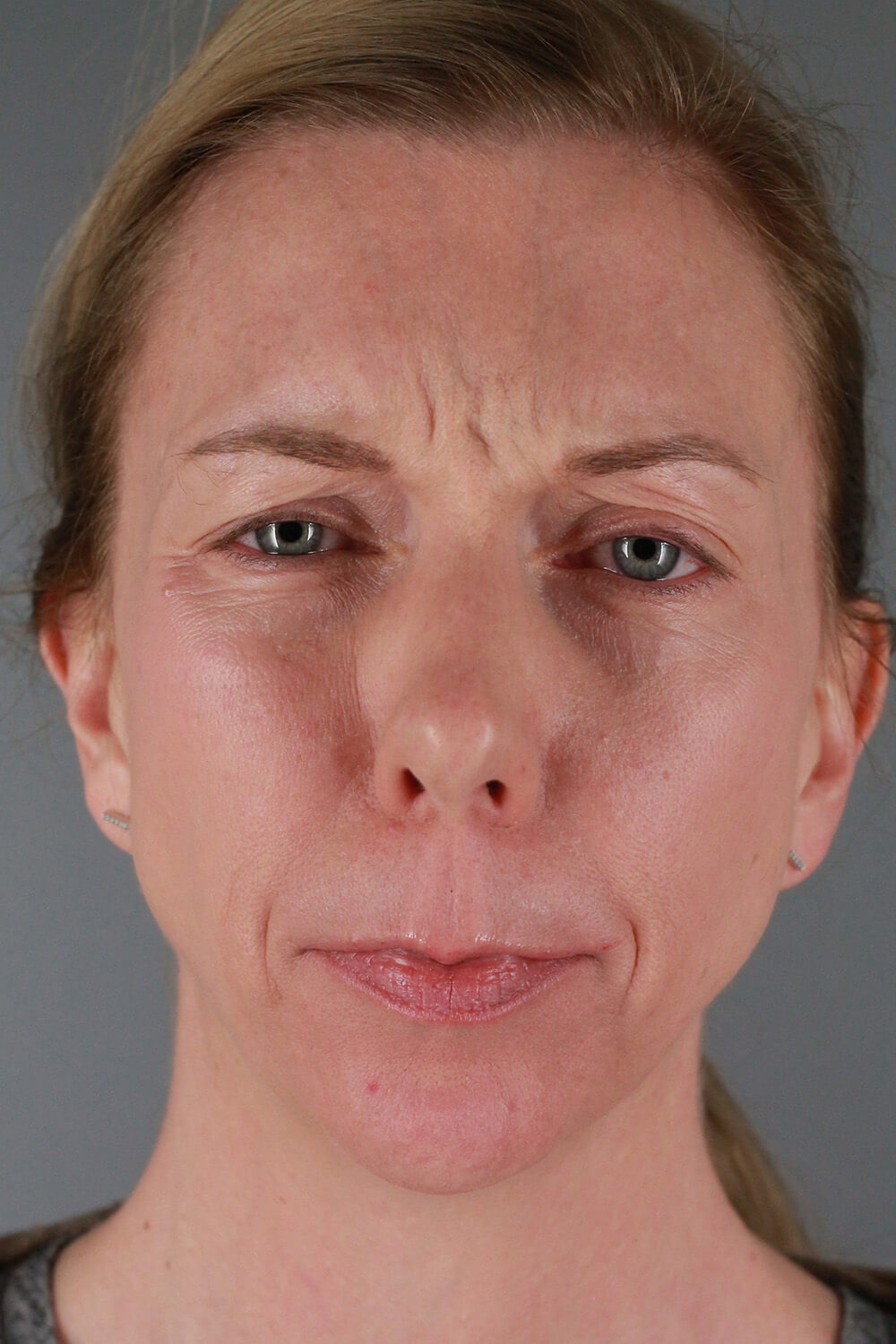 Case--3213 | Before Voluma 2