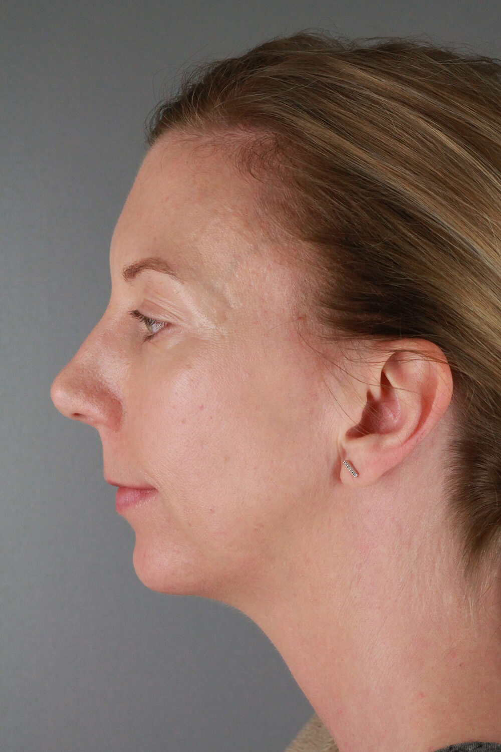 Case--3213 | Before Voluma 3