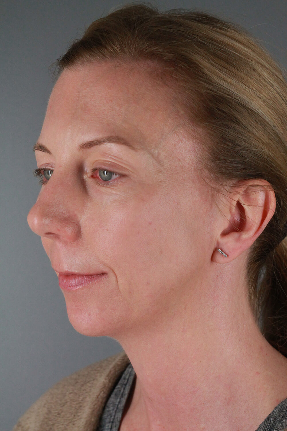 Case--3213 | Before Voluma 4