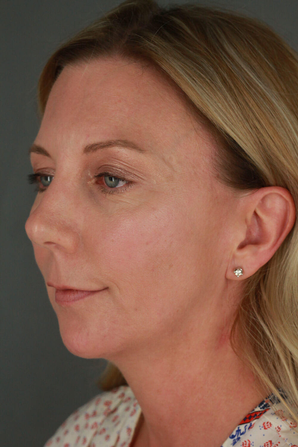 Case--3213 | After Voluma 4