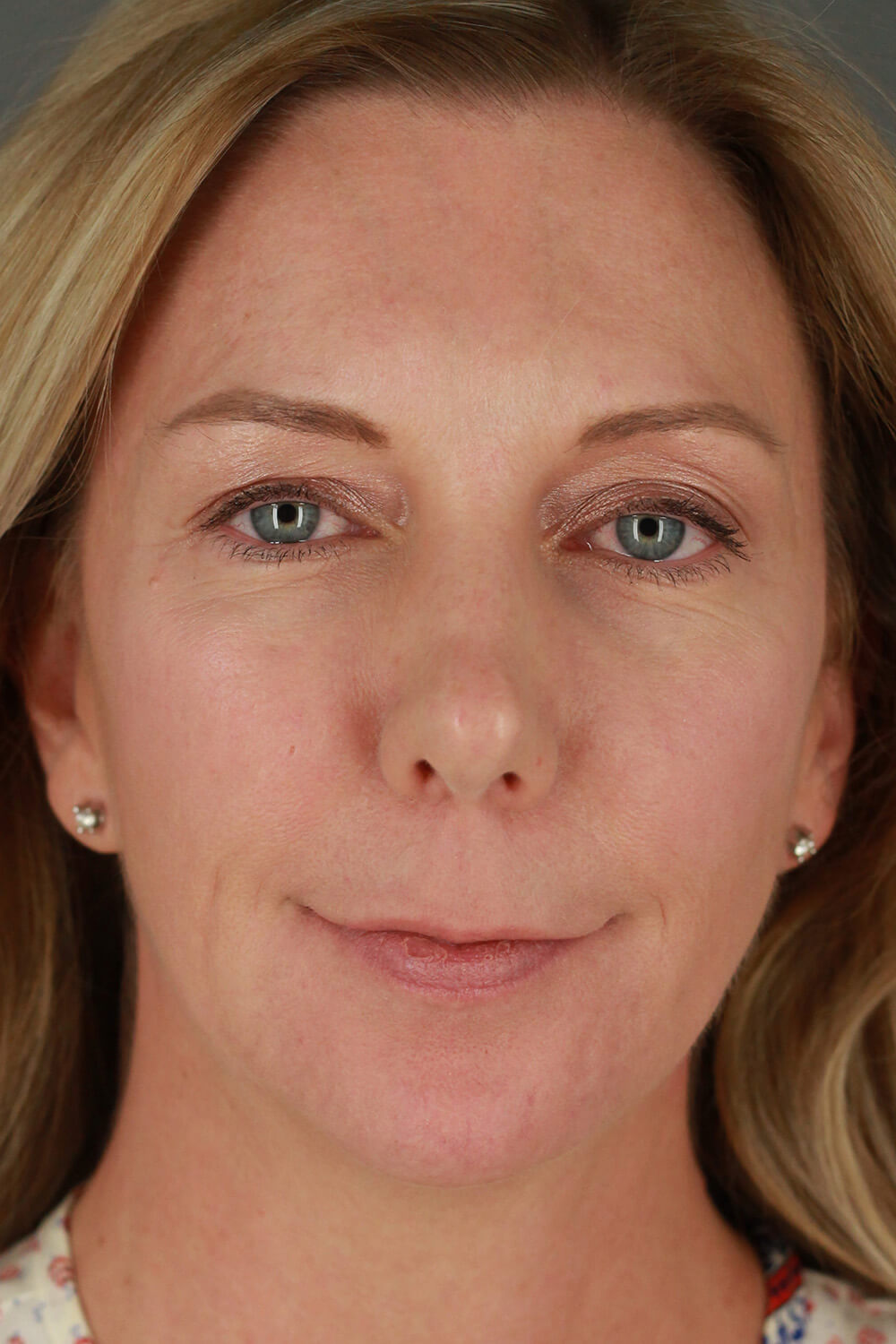 Case--3213 | After Voluma