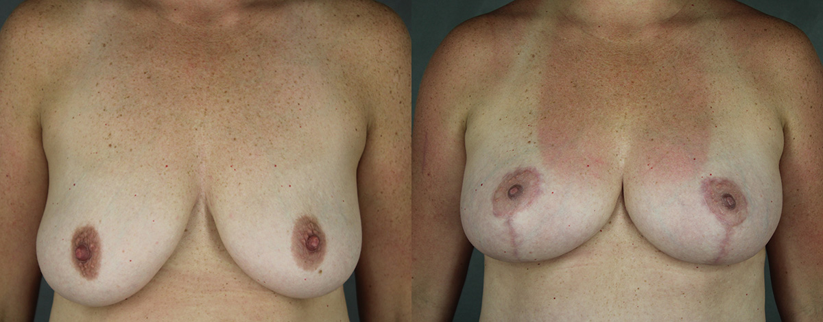 Case--3006 | Before and After Breast Reduction
