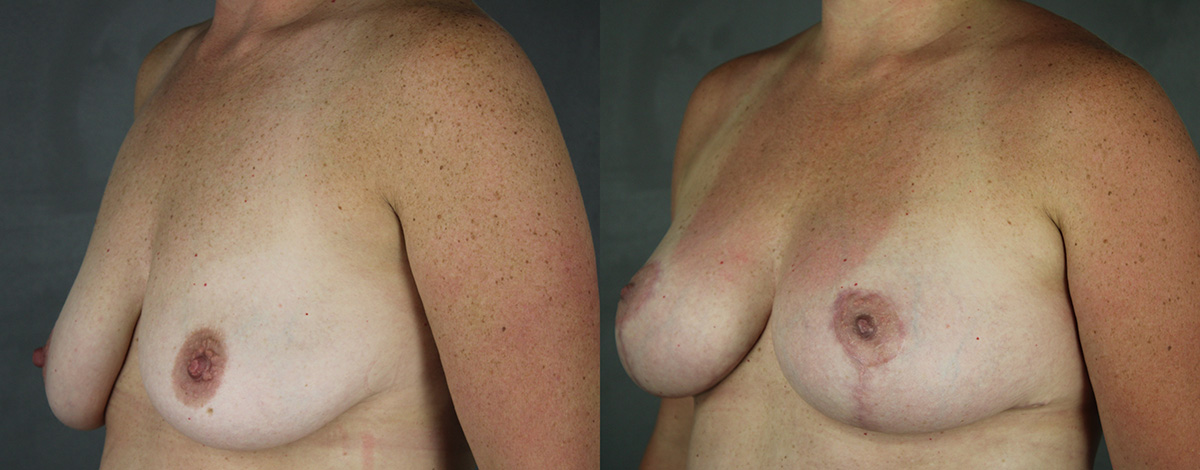 Case--3006 | Before and After Breast Reduction 2