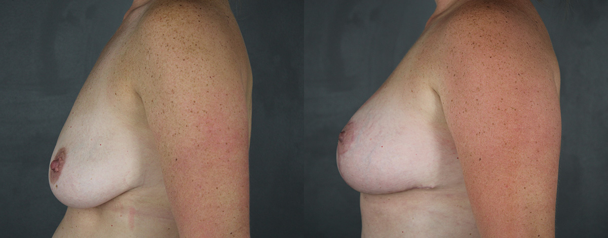 Case--3006 | Before and After Breast Reduction 3