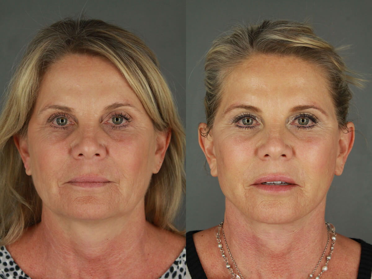 Case--4094 | Before and After Facelift