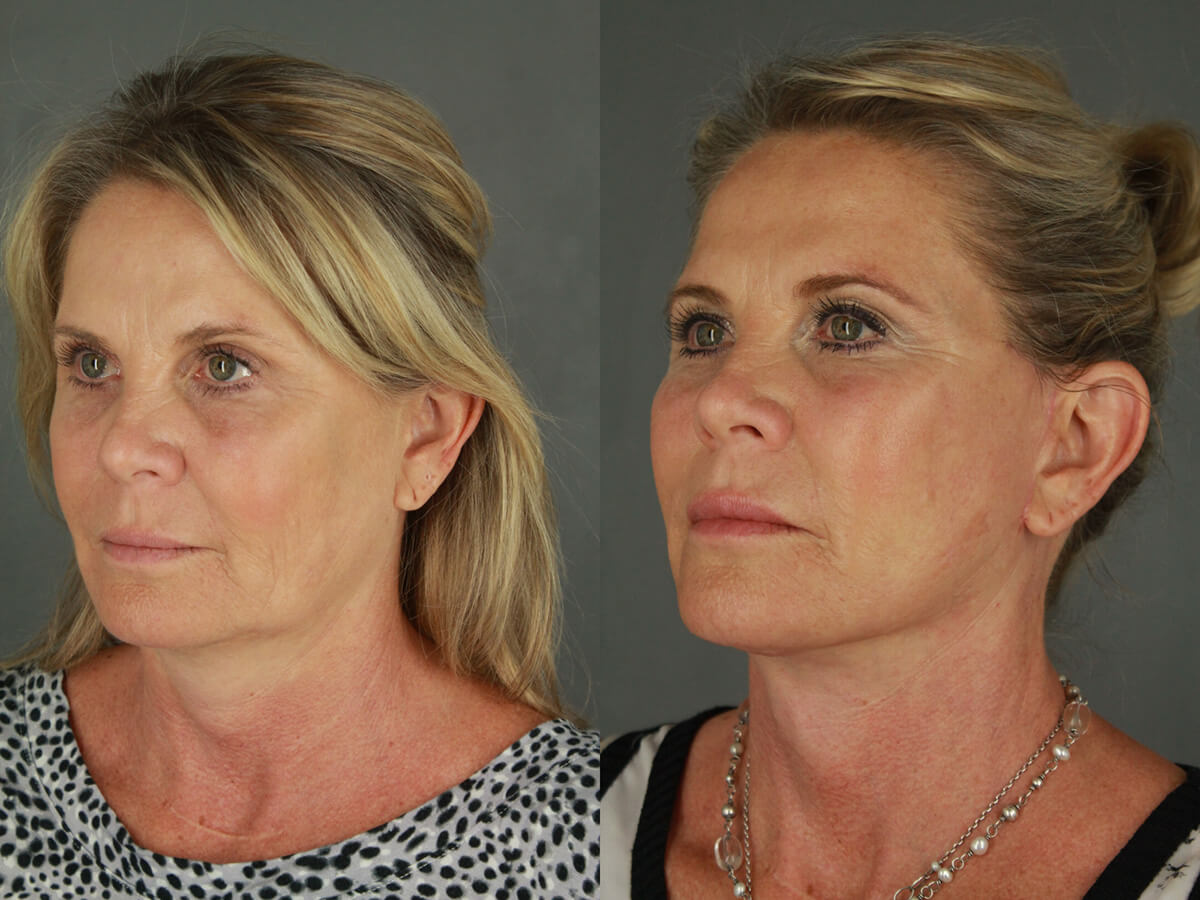 Case--4094 | Before and After Facelift 2