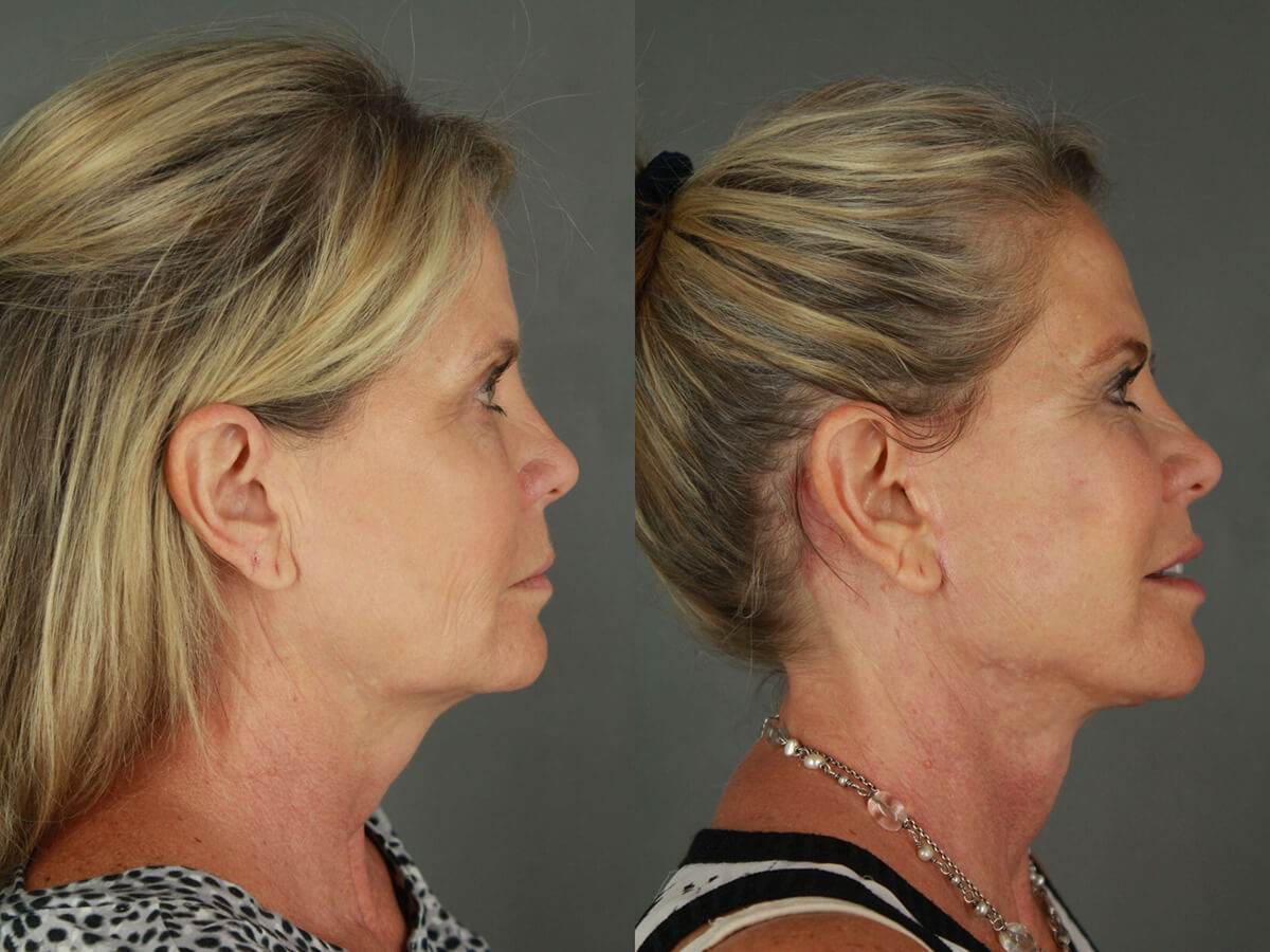 Case--4094 | Before and After Facelift 3