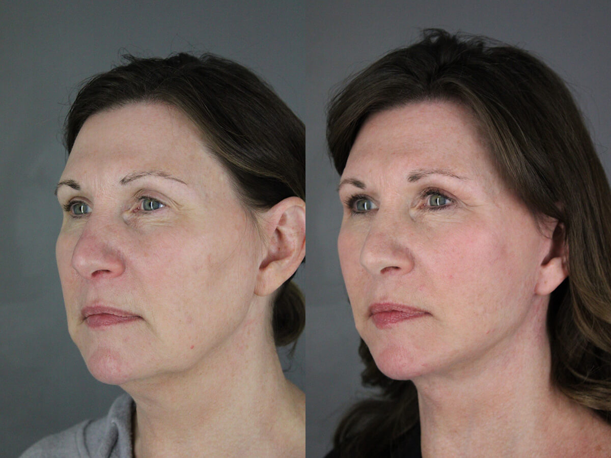 Case--2378 | Before and After Facelift 2
