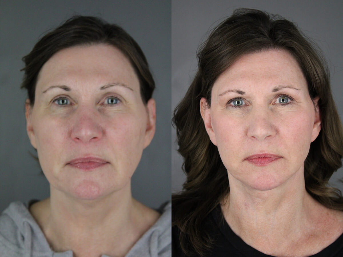 Case--2378 | Before and After Facelift