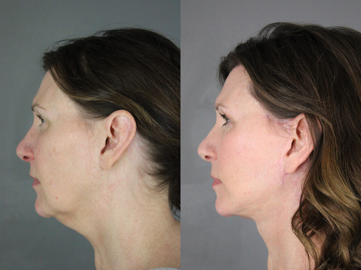 Case--2378 | Before and After Facelift 3