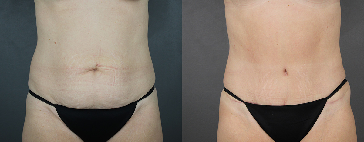 Case--3163 | Before and After Liposuction Procedures