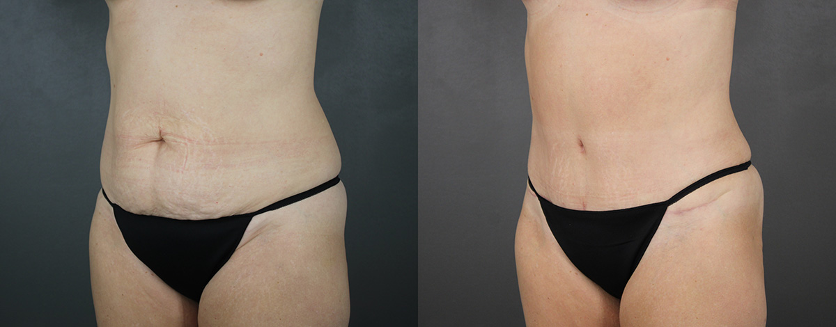 Case--3163 | Before and After Liposuction Procedures 2