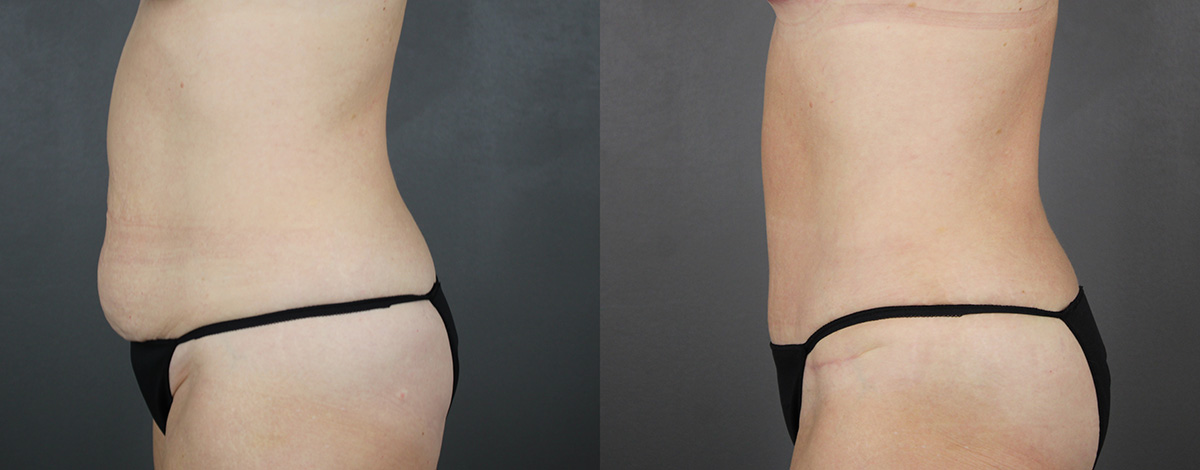 Case--3163 | Before and After Liposuction Procedures 3