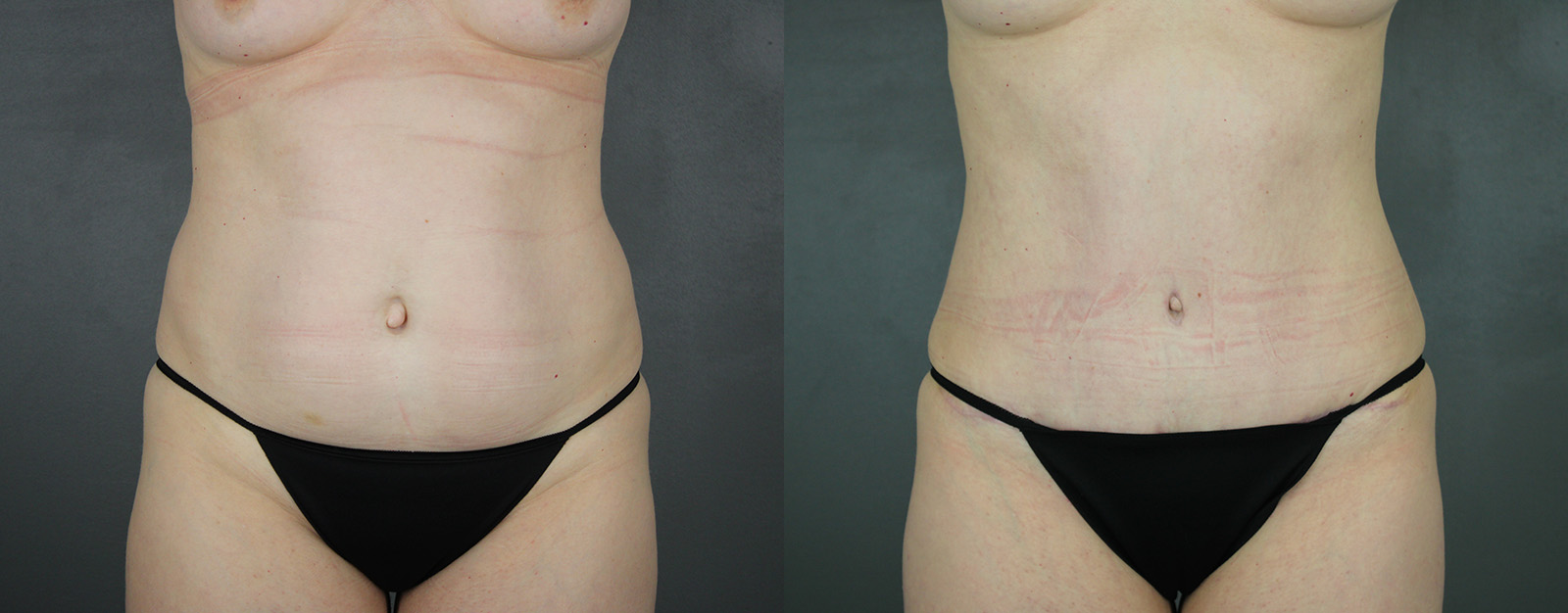 Case--8616 | Before and After Body