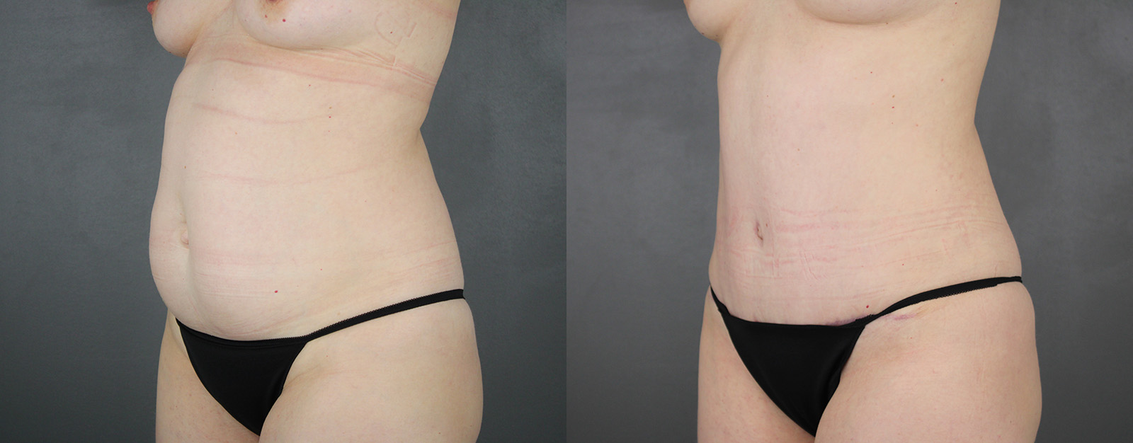 Case--8616 | Before and After Tummy Tuck 2