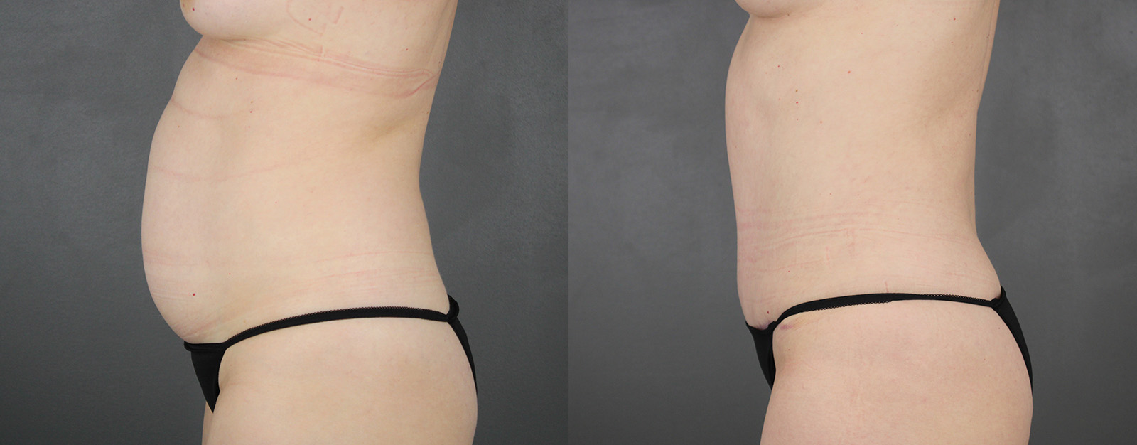 Case--8616 | Before and After Tummy Tuck 3