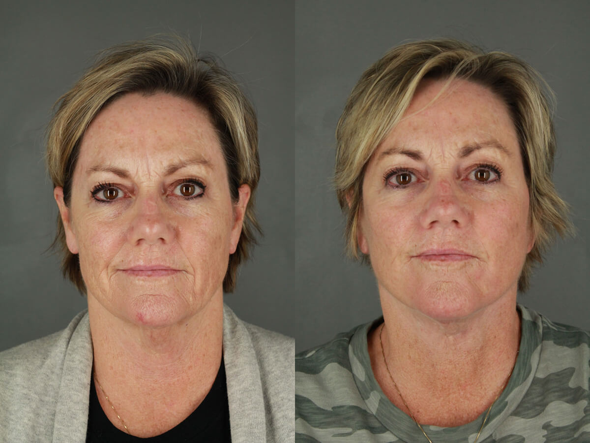 Case--9551 | Before and After Facelift