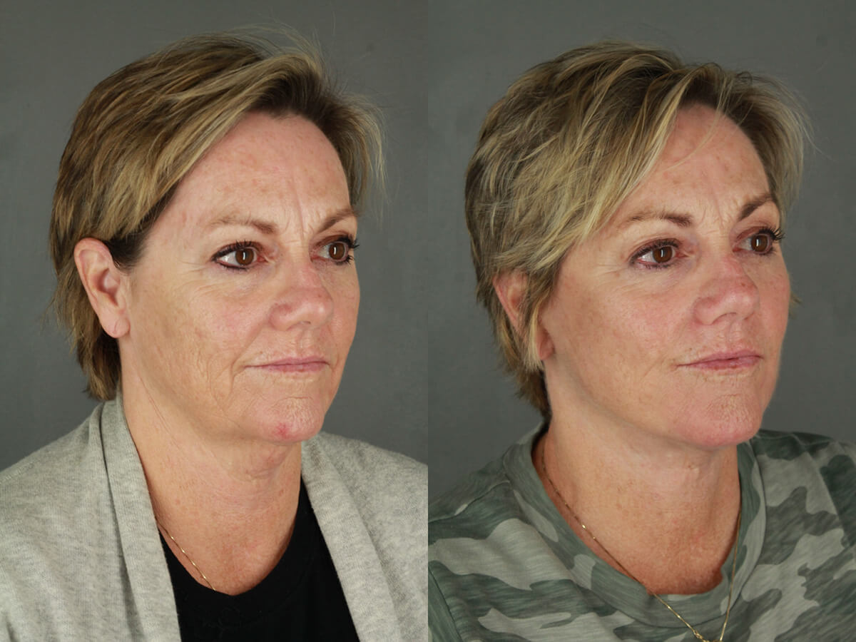 Case--9551 | Before and After Facelift 2