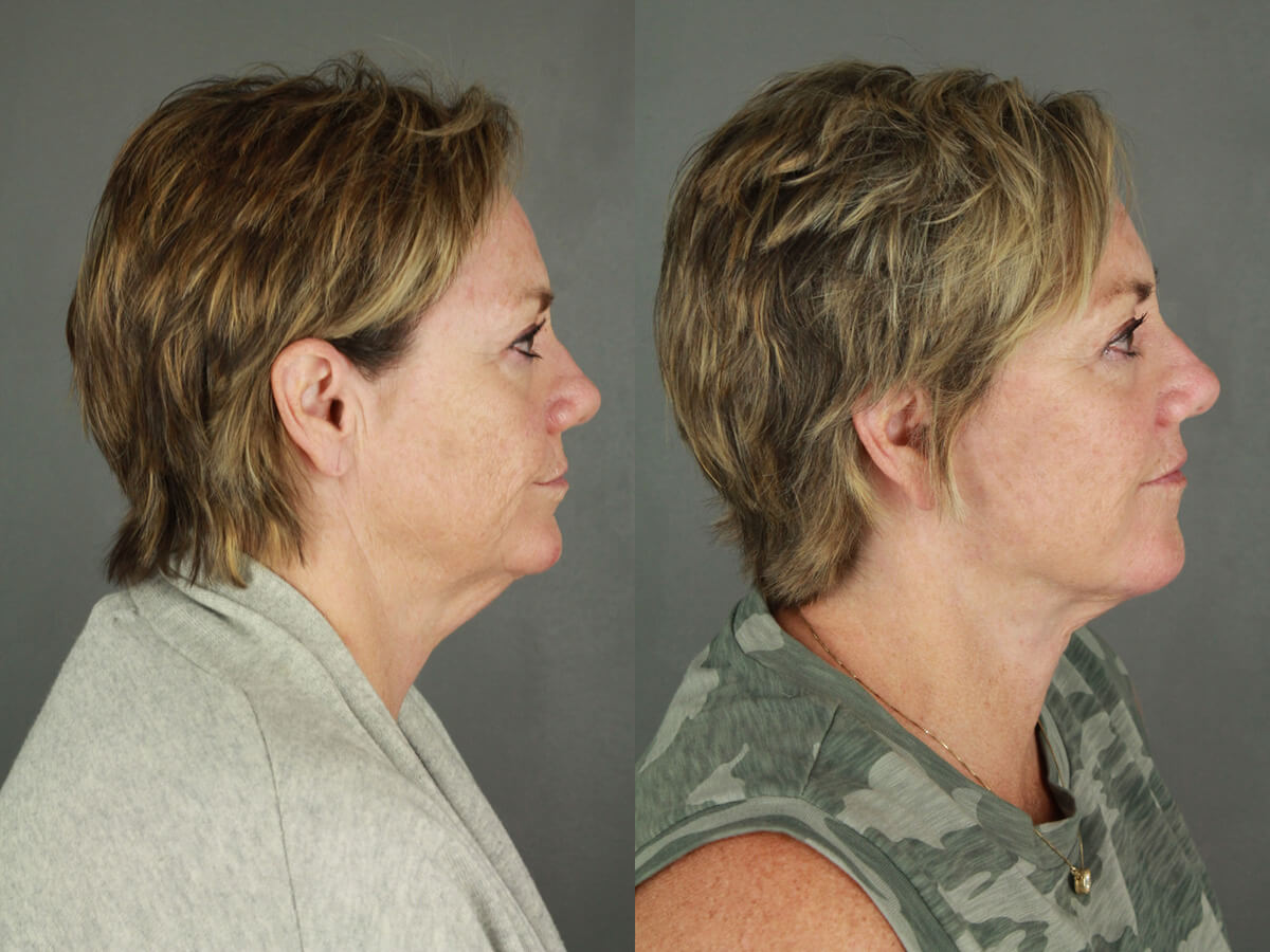 Case--9551 | Before and After Facelift 3