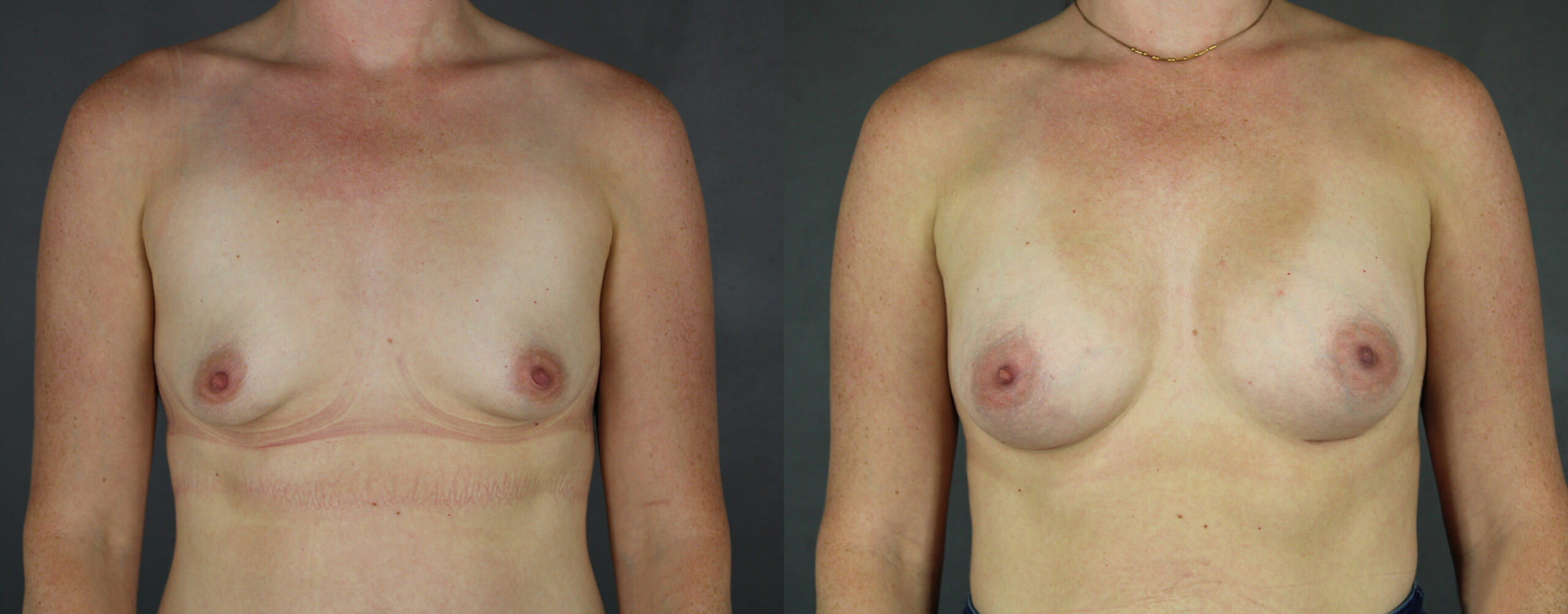 Case--9490 | Before and After Breast Augmentation