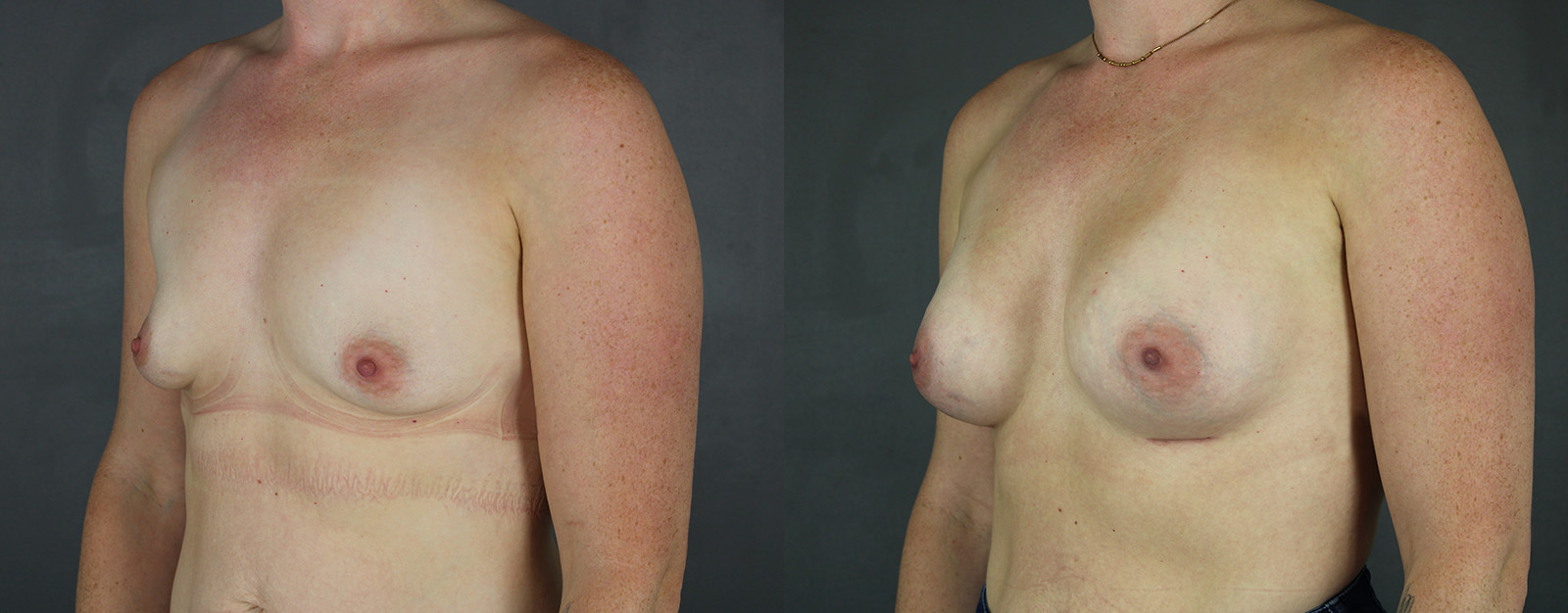 Case--9490 | Before and After Breast Augmentation 2