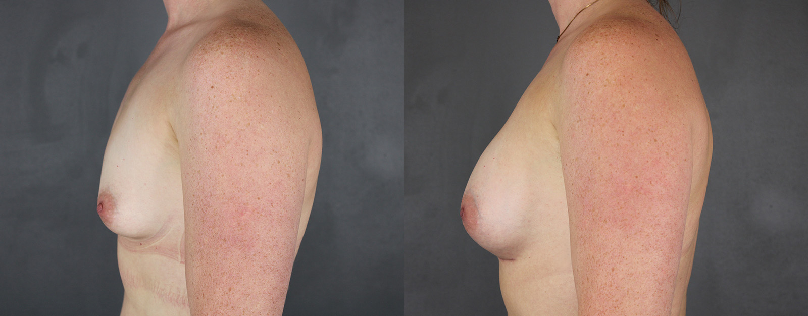 Case--9490 | Before and After Breast Augmentation 3