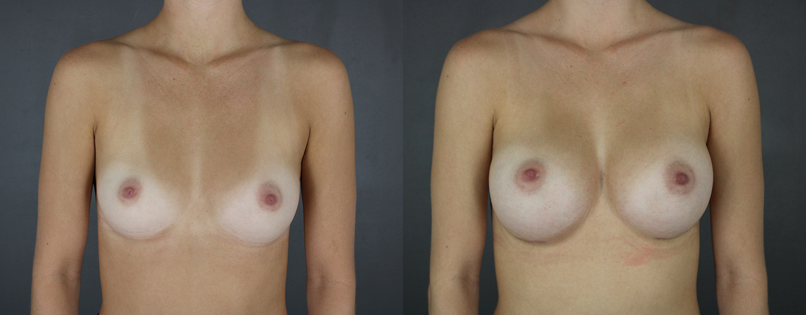 Case--5426 | Before and After Breast Augmentation