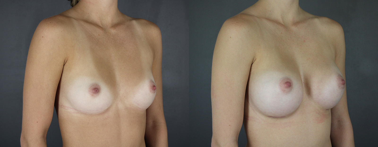 Case--5426 | Before and After Breast Augmentation 2